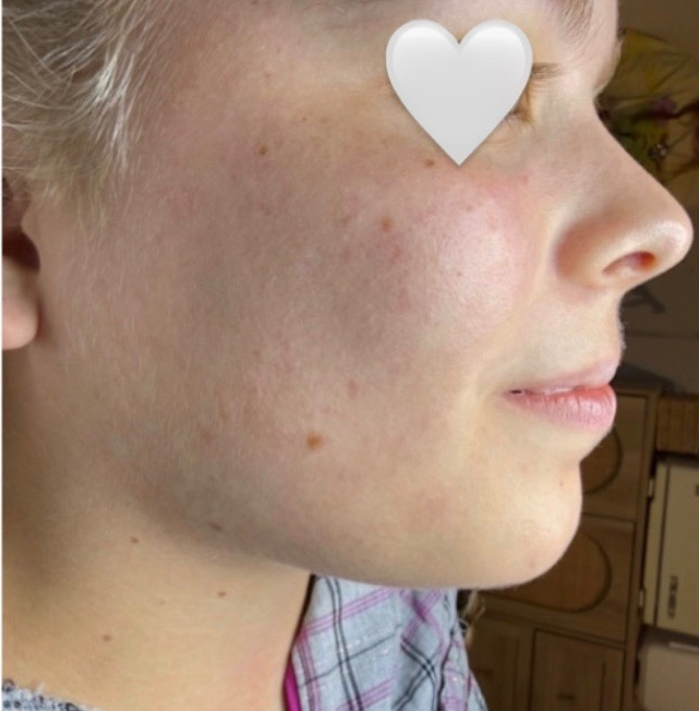 Client skin after a customized acne treatment program