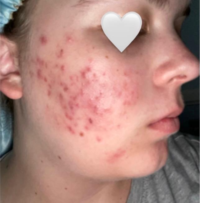 Client skin before a customized acne treatment program